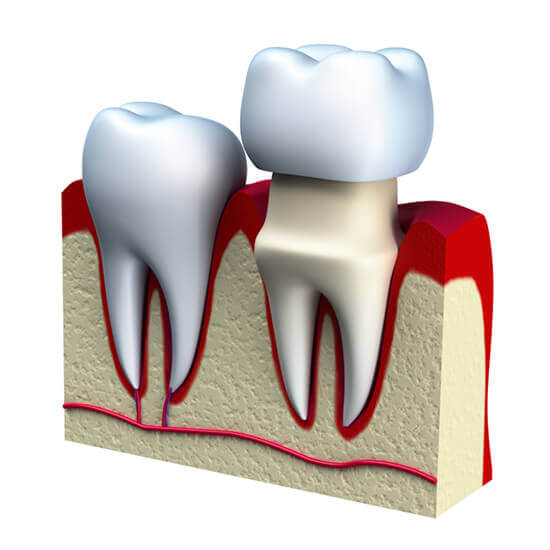 dental crown