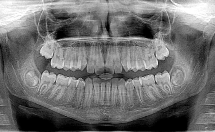 black and white dental X-ray of full set of adult teeth and jawbone