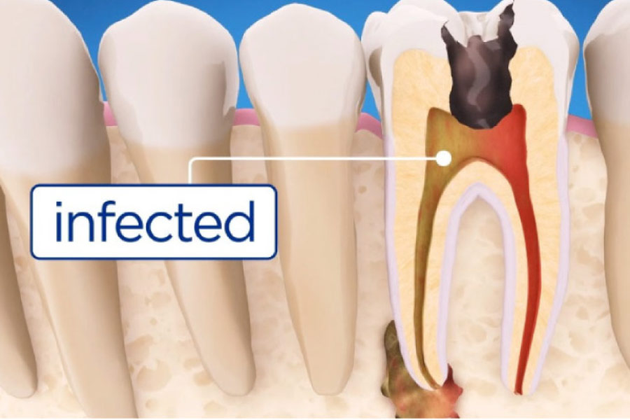 root canal tooth infection illustration
