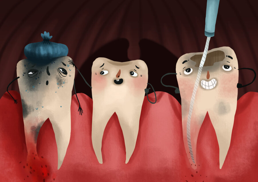 root canal on damaged molar