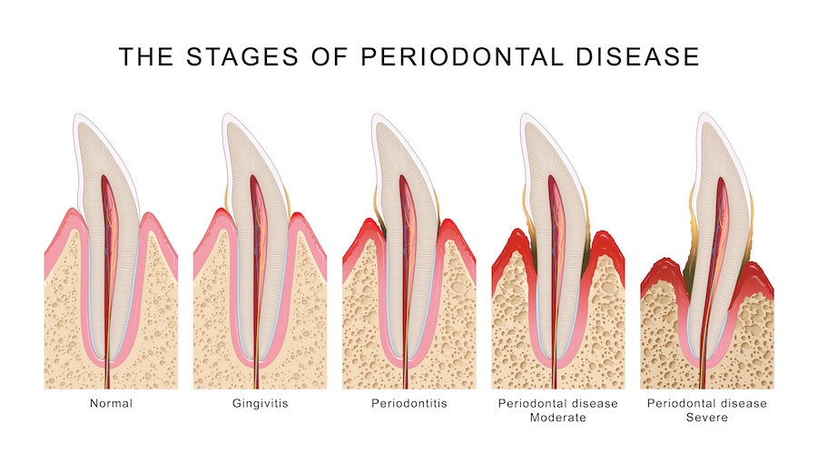 stages of gum disease, periodontal disease